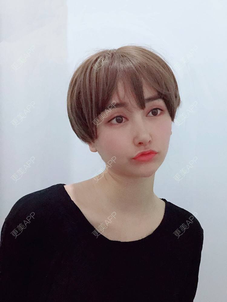 更美 - 是丽丽人儿呀的双眼皮修复经验 | 双眼皮修复 | 开眼角修复