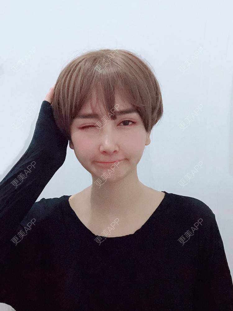 更美 - 是丽丽人儿呀的双眼皮修复经验 | 双眼皮修复 | 开眼角修复