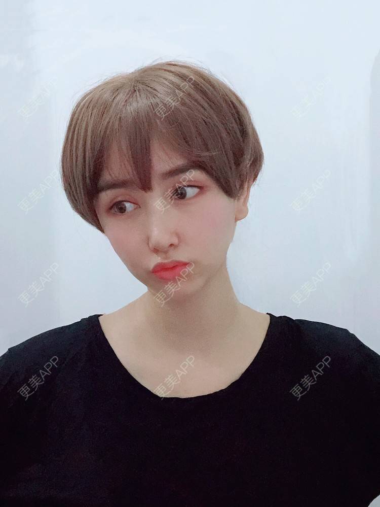 更美 - 是丽丽人儿呀的双眼皮修复经验 | 双眼皮修复 | 开眼角修复