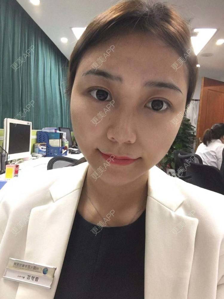 更美 - 更美用户XyX5wyKSYE的激光淡化黑眼圈经验 | 胶原蛋白淡化黑眼圈 | 自体脂肪淡化黑眼圈 | 激光淡化黑眼圈 | 玻尿酸黑眼圈 | 广州
