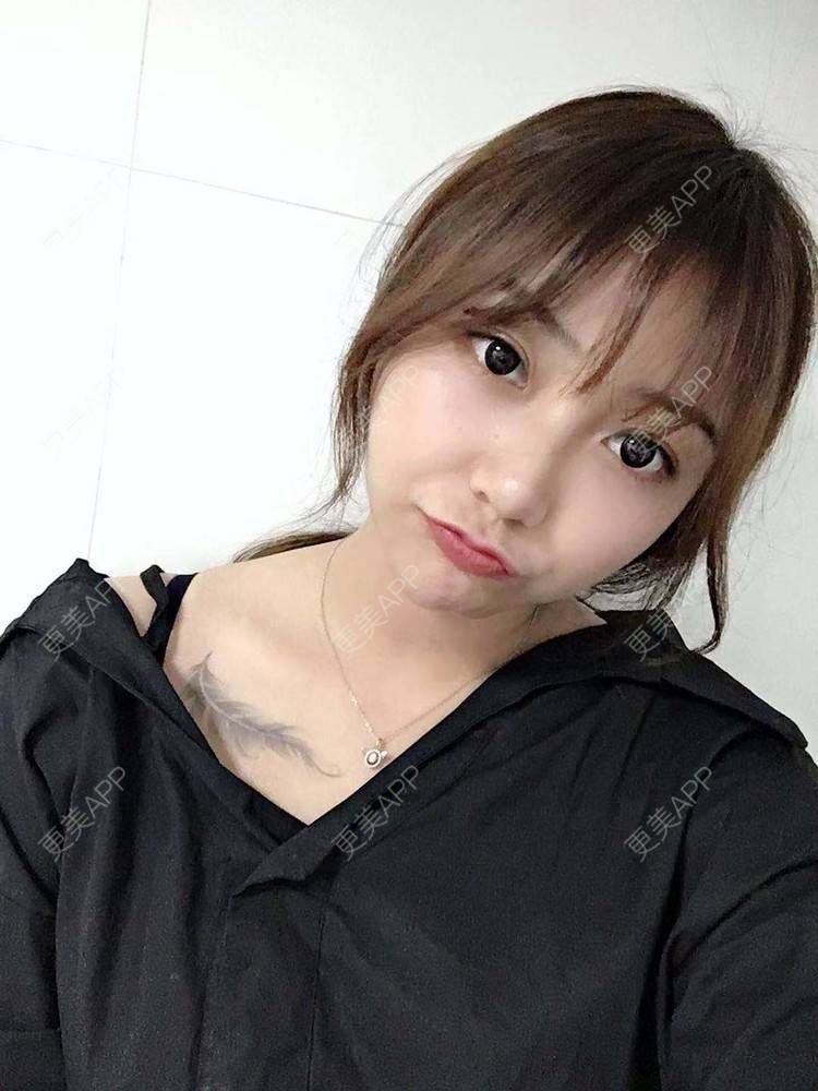 更美 - 更美用户XyX5wyKSYE的激光淡化黑眼圈经验 | 胶原蛋白淡化黑眼圈 | 自体脂肪淡化黑眼圈 | 激光淡化黑眼圈 | 玻尿酸黑眼圈 | 广州