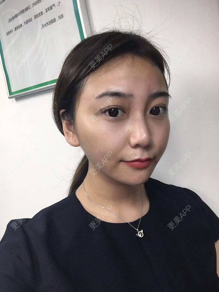 更美 - 更美用户XyX5wyKSYE的激光淡化黑眼圈经验 | 胶原蛋白淡化黑眼圈 | 自体脂肪淡化黑眼圈 | 激光淡化黑眼圈 | 玻尿酸黑眼圈 | 广州