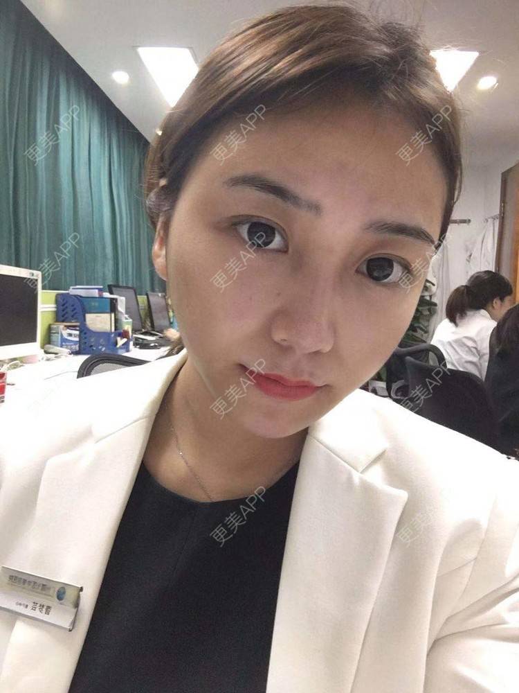 更美 - 更美用户XyX5wyKSYE的激光淡化黑眼圈经验 | 胶原蛋白淡化黑眼圈 | 自体脂肪淡化黑眼圈 | 激光淡化黑眼圈 | 玻尿酸黑眼圈 | 广州