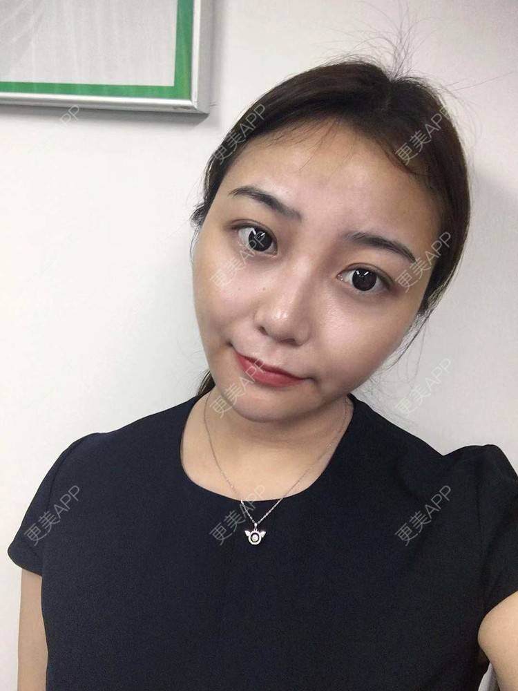 更美 - 更美用户XyX5wyKSYE的激光淡化黑眼圈经验 | 胶原蛋白淡化黑眼圈 | 自体脂肪淡化黑眼圈 | 激光淡化黑眼圈 | 玻尿酸黑眼圈 | 广州