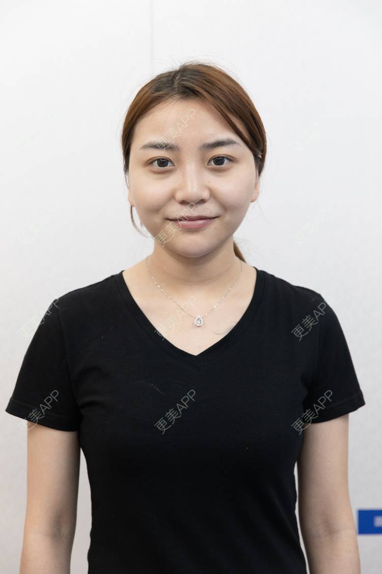 更美 - 更美用户XyX5wyKSYE的激光淡化黑眼圈经验 | 胶原蛋白淡化黑眼圈 | 自体脂肪淡化黑眼圈 | 激光淡化黑眼圈 | 玻尿酸黑眼圈 | 广州