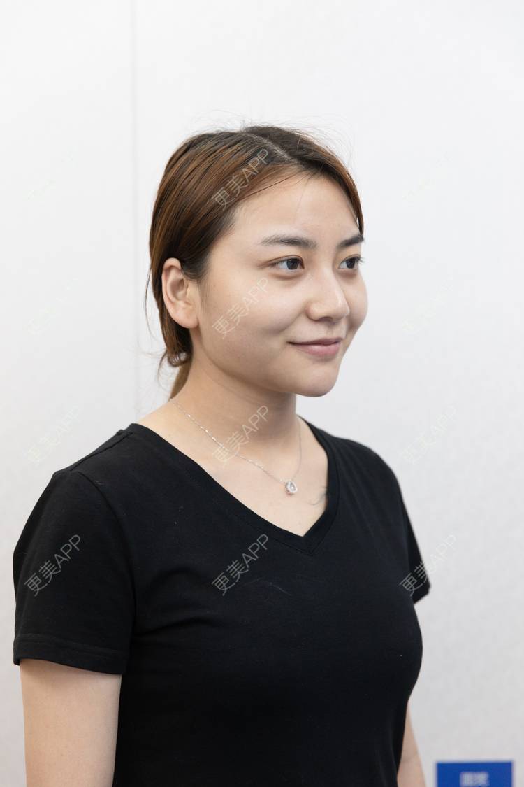 更美 - 更美用户XyX5wyKSYE的激光淡化黑眼圈经验 | 胶原蛋白淡化黑眼圈 | 自体脂肪淡化黑眼圈 | 激光淡化黑眼圈 | 玻尿酸黑眼圈 | 广州