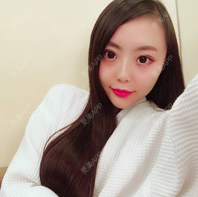 更美 - 更美用户QhDs9RVr2A的玻尿酸面部细纹经验 | 上海 | 玻尿酸面部细纹