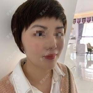 更美 - 更美用户o9647lu9Ax的激光淡斑经验 | 激光淡斑 | 深圳