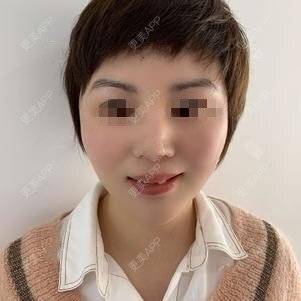 更美 - 更美用户o9647lu9Ax的激光淡斑经验 | 激光淡斑 | 深圳