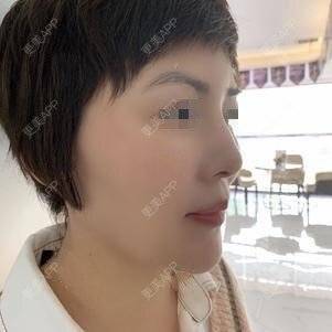 更美 - 更美用户o9647lu9Ax的激光淡斑经验 | 激光淡斑 | 深圳