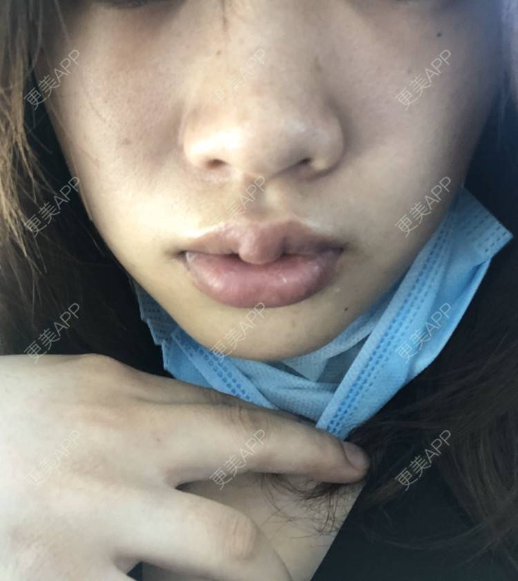 更美 - 小菲菲1992的M唇成形经验 | 武汉 | M唇成形