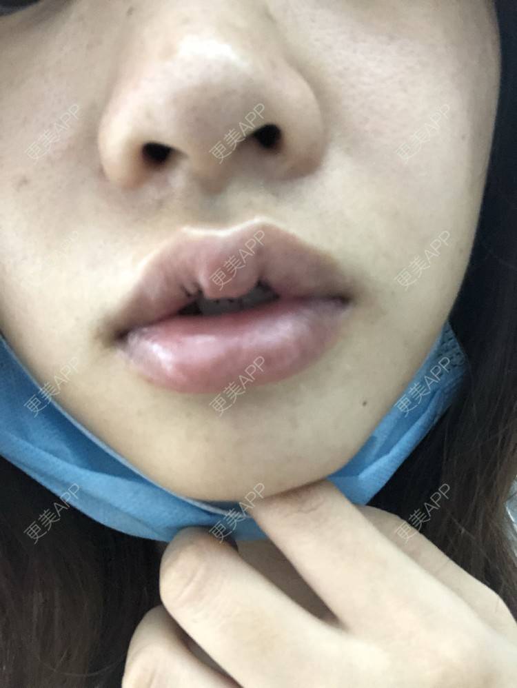 更美 - 小菲菲1992的M唇成形经验 | 武汉 | M唇成形