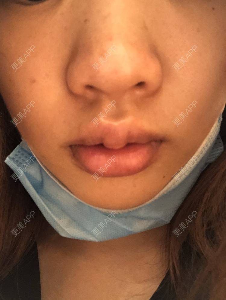 更美 - 小菲菲1992的M唇成形经验 | 武汉 | M唇成形