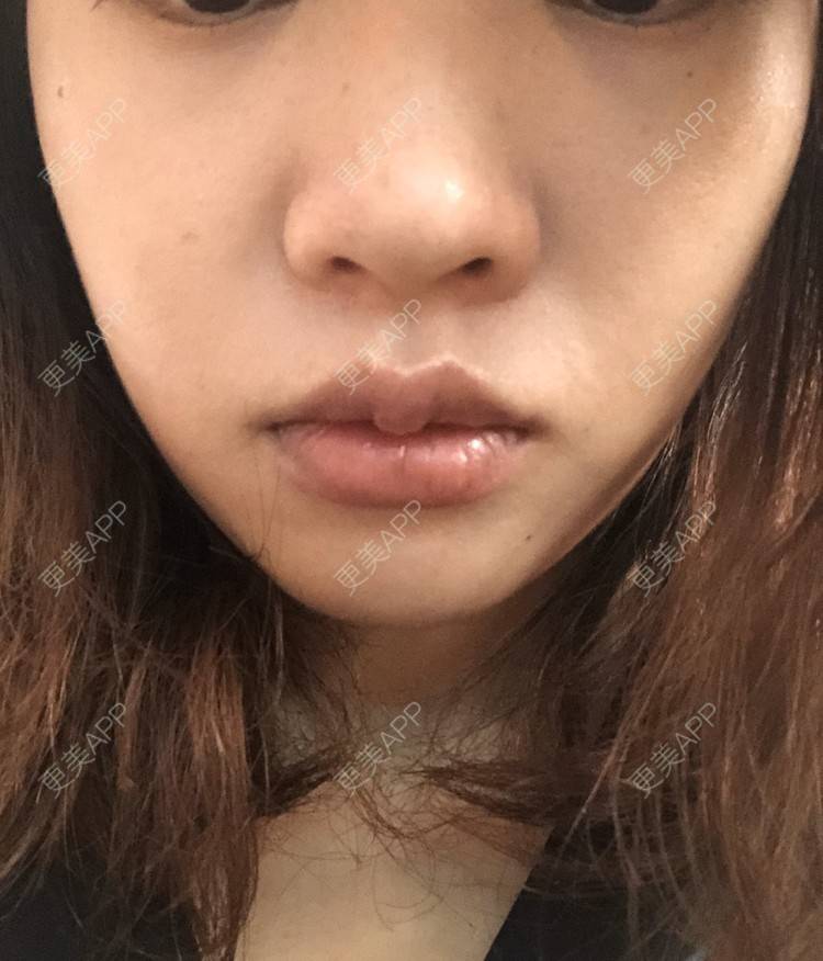 更美 - 小菲菲1992的M唇成形经验 | 武汉 | M唇成形