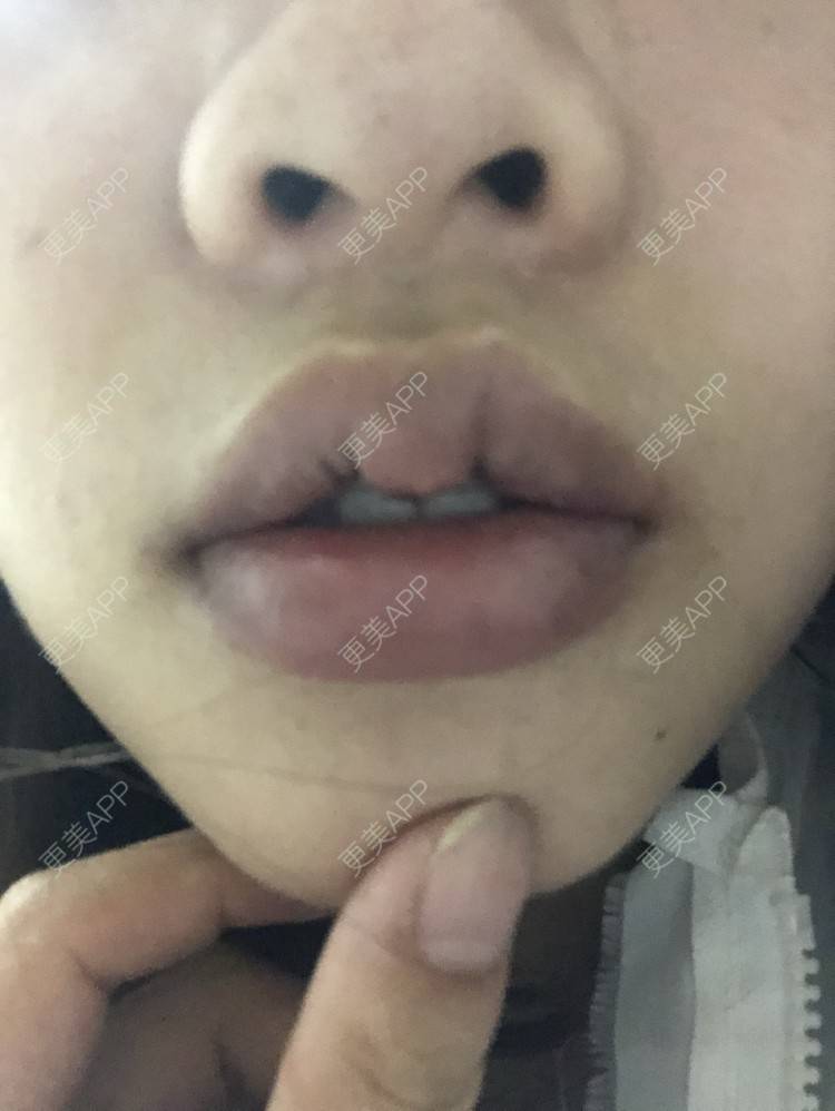 更美 - 小菲菲1992的M唇成形经验 | 武汉 | M唇成形