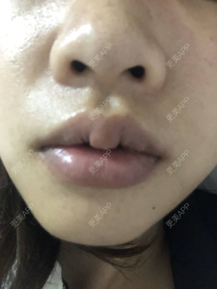 更美 - 小菲菲1992的M唇成形经验 | 武汉 | M唇成形