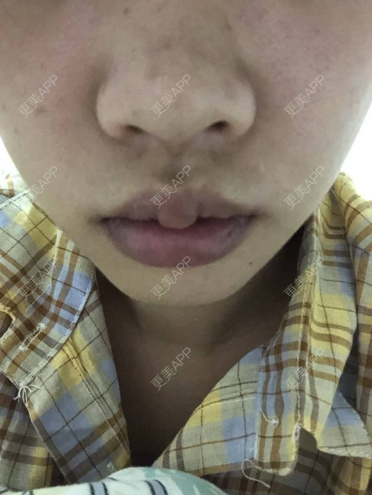 更美 - 小菲菲1992的M唇成形经验 | 武汉 | M唇成形