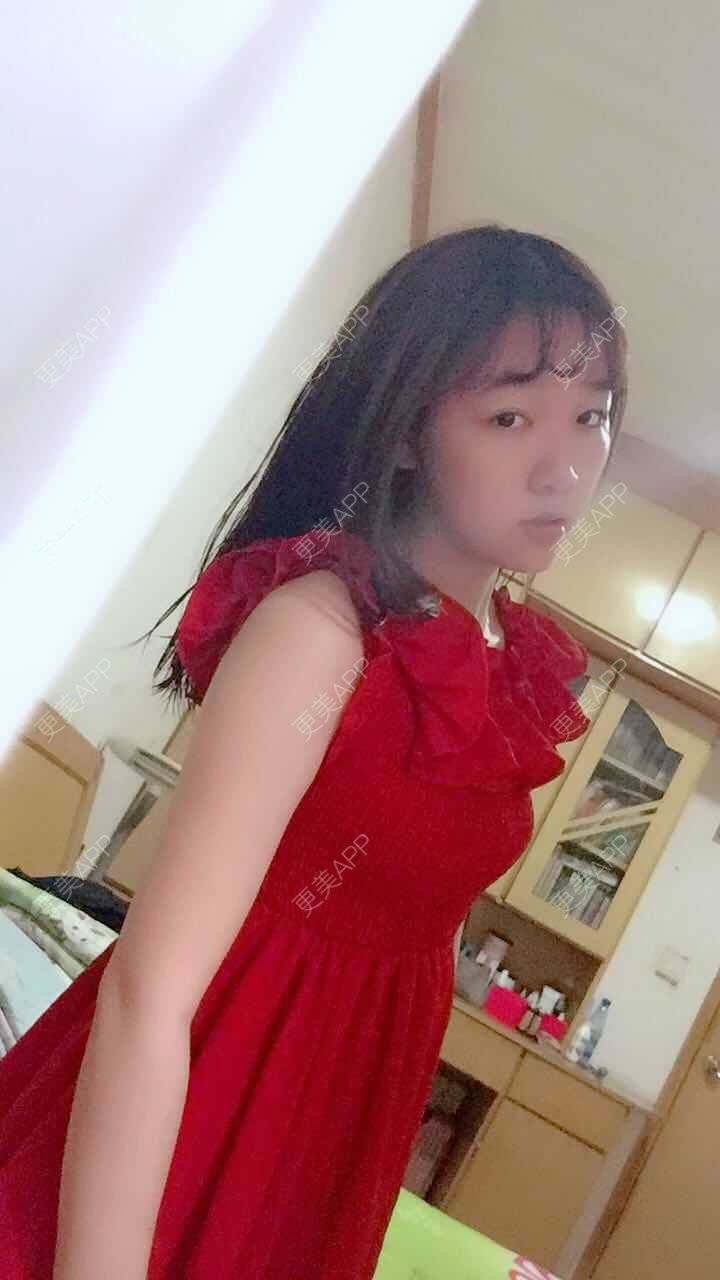 更美 - 阳光灿烂的微笑的背部吸脂经验 | 背部吸脂 | 武汉