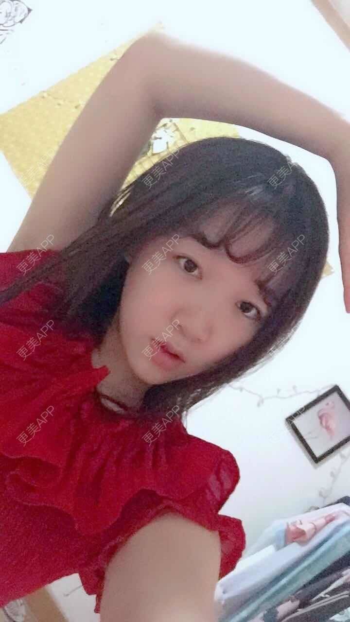 更美 - 阳光灿烂的微笑的背部吸脂经验 | 背部吸脂 | 武汉