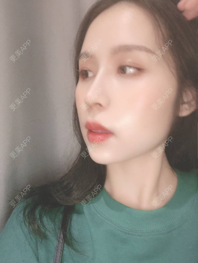 更美 - 超级超级好吃的下巴经验 | 膨体垫下巴 | 硅胶垫下巴 | 缩下巴 | 宽下巴矫正 | 人工骨垫下巴 | 玻尿酸下巴 | 自体脂肪垫下巴 | 胶原蛋白丰下巴