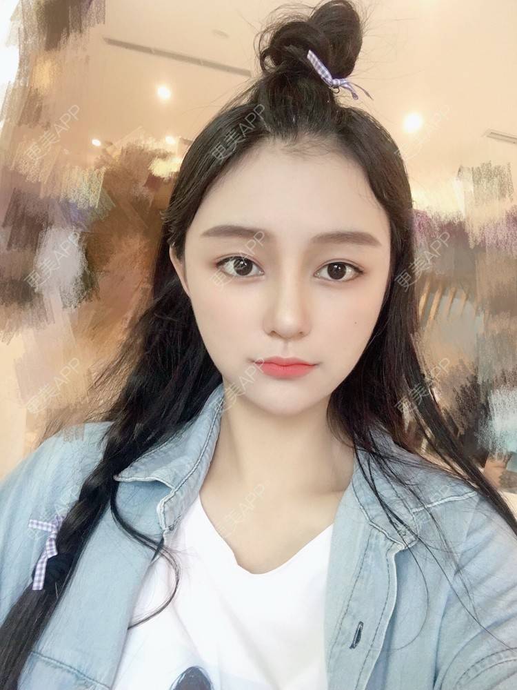 猪猪女孩me的隆鼻日记