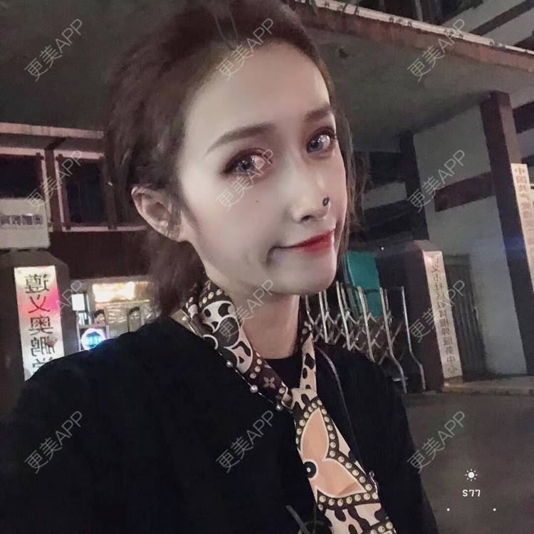 更美 - 丢了灵魂的孩纸的唇腭裂修复经验 | 厚唇改薄 | 唇腭裂修复 | 玻尿酸唇部 | 自体脂肪丰唇 | 胶原蛋白丰唇