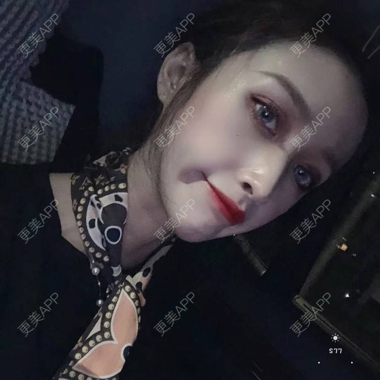更美 - 丢了灵魂的孩纸的唇腭裂修复经验 | 厚唇改薄 | 唇腭裂修复 | 玻尿酸唇部 | 自体脂肪丰唇 | 胶原蛋白丰唇