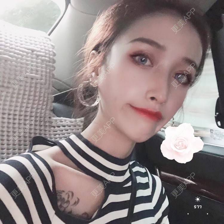 更美 - 丢了灵魂的孩纸的唇腭裂修复经验 | 厚唇改薄 | 唇腭裂修复 | 玻尿酸唇部 | 自体脂肪丰唇 | 胶原蛋白丰唇