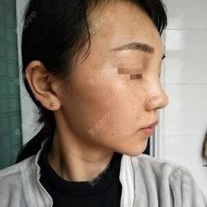 更美 - 更美用户lxD5uA89cw的激光淡斑经验 | 激光淡斑 | 皮秒激光 | 深圳