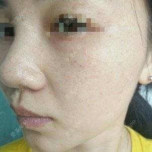 更美 - 更美用户lxD5uA89cw的激光淡斑经验 | 激光淡斑 | 皮秒激光 | 深圳