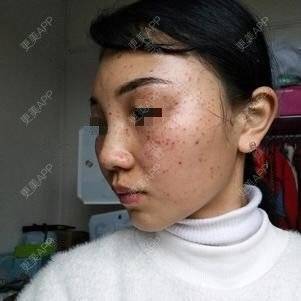 更美 - 更美用户lxD5uA89cw的激光淡斑经验 | 激光淡斑 | 皮秒激光 | 深圳