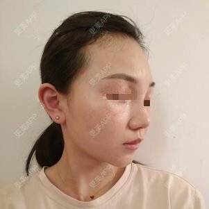 更美 - 更美用户lxD5uA89cw的激光淡斑经验 | 激光淡斑 | 皮秒激光 | 深圳