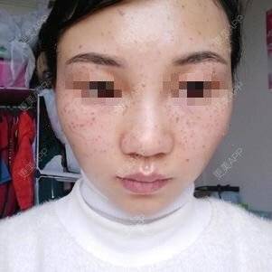更美 - 更美用户lxD5uA89cw的激光淡斑经验 | 激光淡斑 | 皮秒激光 | 深圳