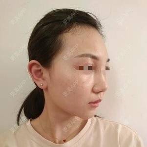 更美 - 更美用户lxD5uA89cw的激光淡斑经验 | 激光淡斑 | 皮秒激光 | 深圳