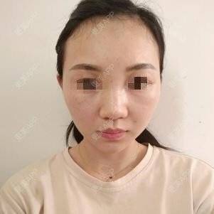 更美 - 更美用户lxD5uA89cw的激光淡斑经验 | 激光淡斑 | 皮秒激光 | 深圳