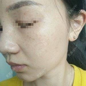 更美 - 更美用户lxD5uA89cw的激光淡斑经验 | 激光淡斑 | 皮秒激光 | 深圳