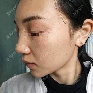 更美 - 更美用户lxD5uA89cw的激光淡斑经验 | 激光淡斑 | 皮秒激光 | 深圳