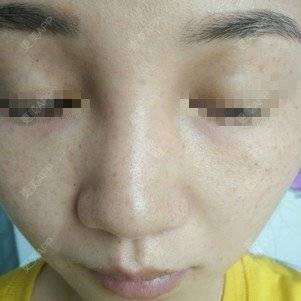 更美 - 更美用户lxD5uA89cw的激光淡斑经验 | 激光淡斑 | 皮秒激光 | 深圳