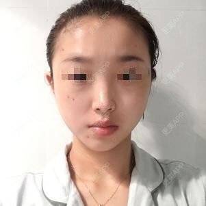 更美 - 更美用户0JzmZWVxPX的玻尿酸导入经验 | 玻尿酸导入 | 微针水光 | 深圳