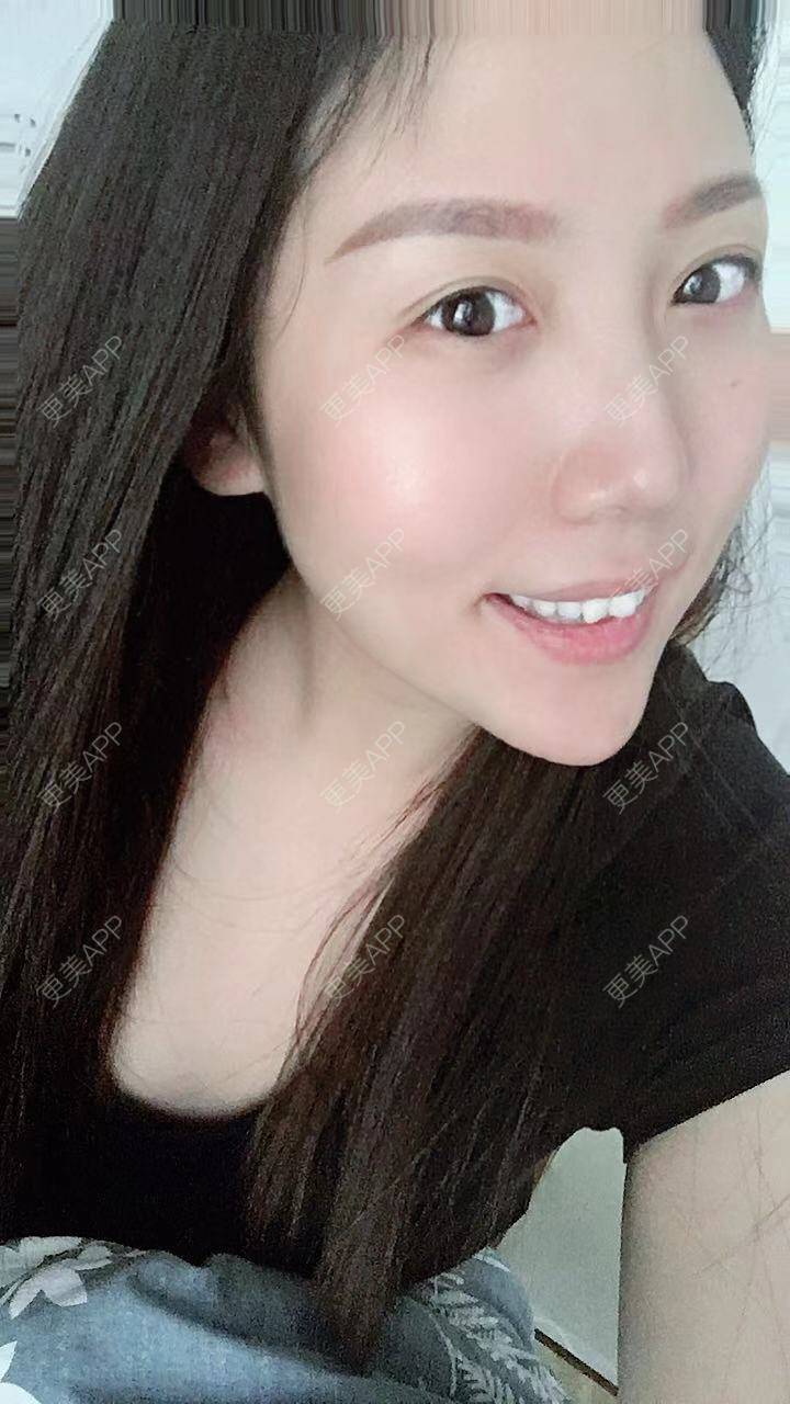 更美 - 身野心安稳赘的微笑唇手术经验 | 成都 | 微笑唇手术