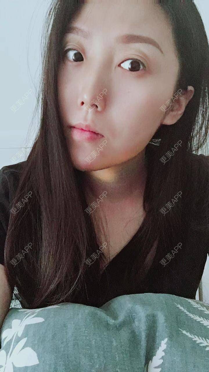 更美 - 身野心安稳赘的微笑唇手术经验 | 成都 | 微笑唇手术