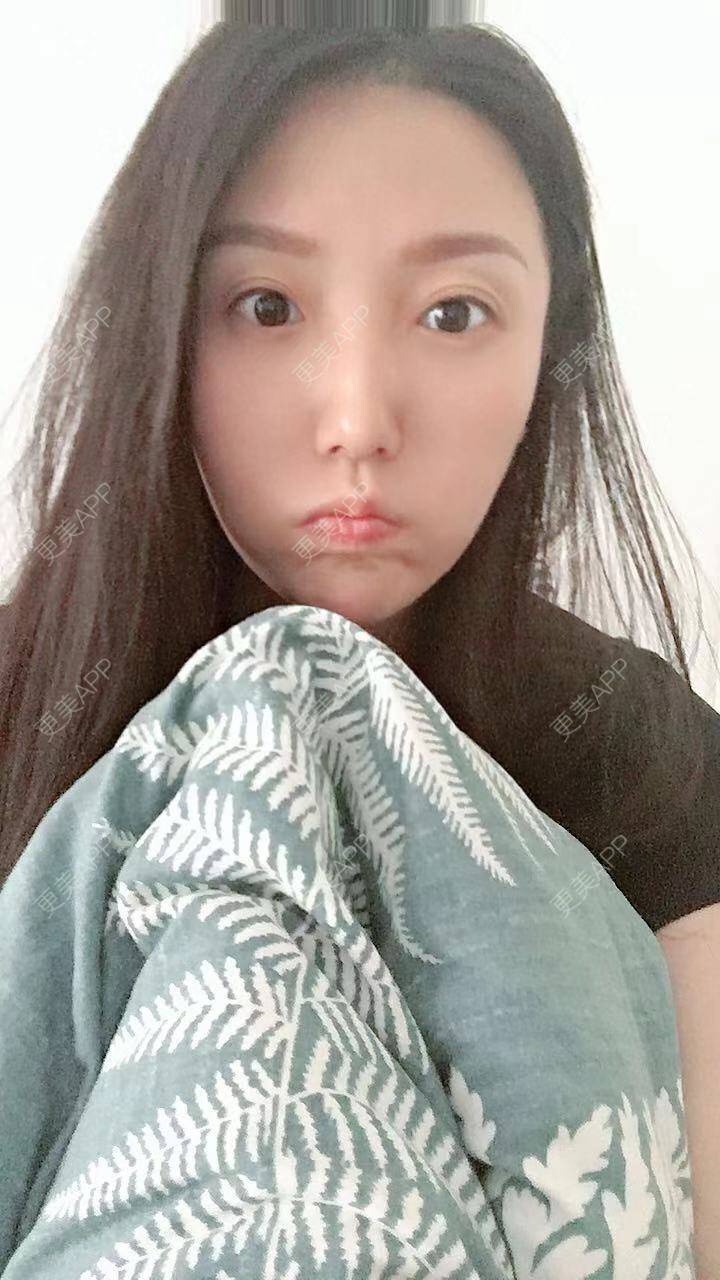 更美 - 身野心安稳赘的微笑唇手术经验 | 成都 | 微笑唇手术