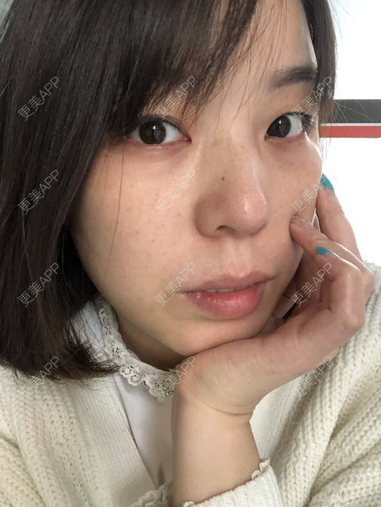 更美 - 彩儿er的激光淡斑经验 | 成都 | 激光淡斑