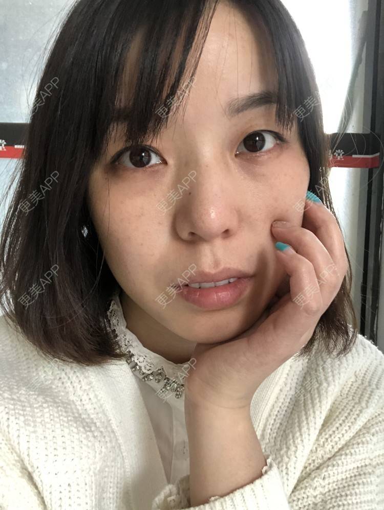 更美 - 彩儿er的激光淡斑经验 | 成都 | 激光淡斑