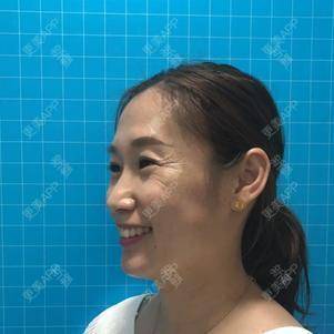 更美 - 大连维恩柏颜医疗美容门诊部的热玛吉经验 | 热玛吉