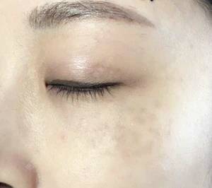更美 - 更美用户r7ZFQBkfq8的激光淡斑经验 | 激光淡斑 | 深圳
