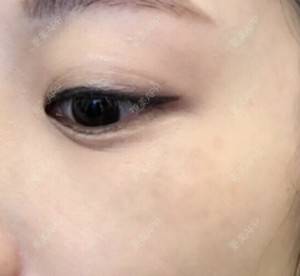 更美 - 更美用户r7ZFQBkfq8的激光淡斑经验 | 激光淡斑 | 深圳