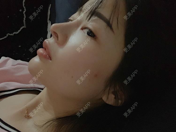 更美 - 更美用户LqNpDI51P1的玻尿酸下巴经验 | 玻尿酸下巴 | 武汉