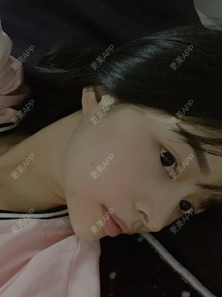 更美 - 更美用户LqNpDI51P1的玻尿酸下巴经验 | 玻尿酸下巴 | 武汉