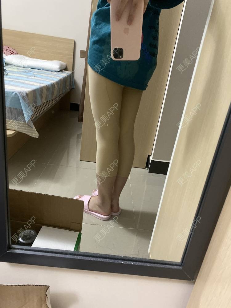 婷婷玉立6的吸脂瘦大腿日记